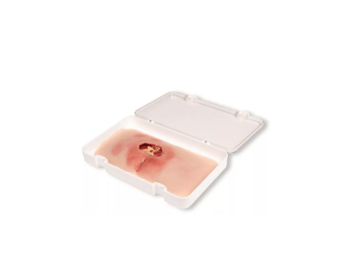 Wundmoulage sakraler Dekubitus - Erler - Zimmer