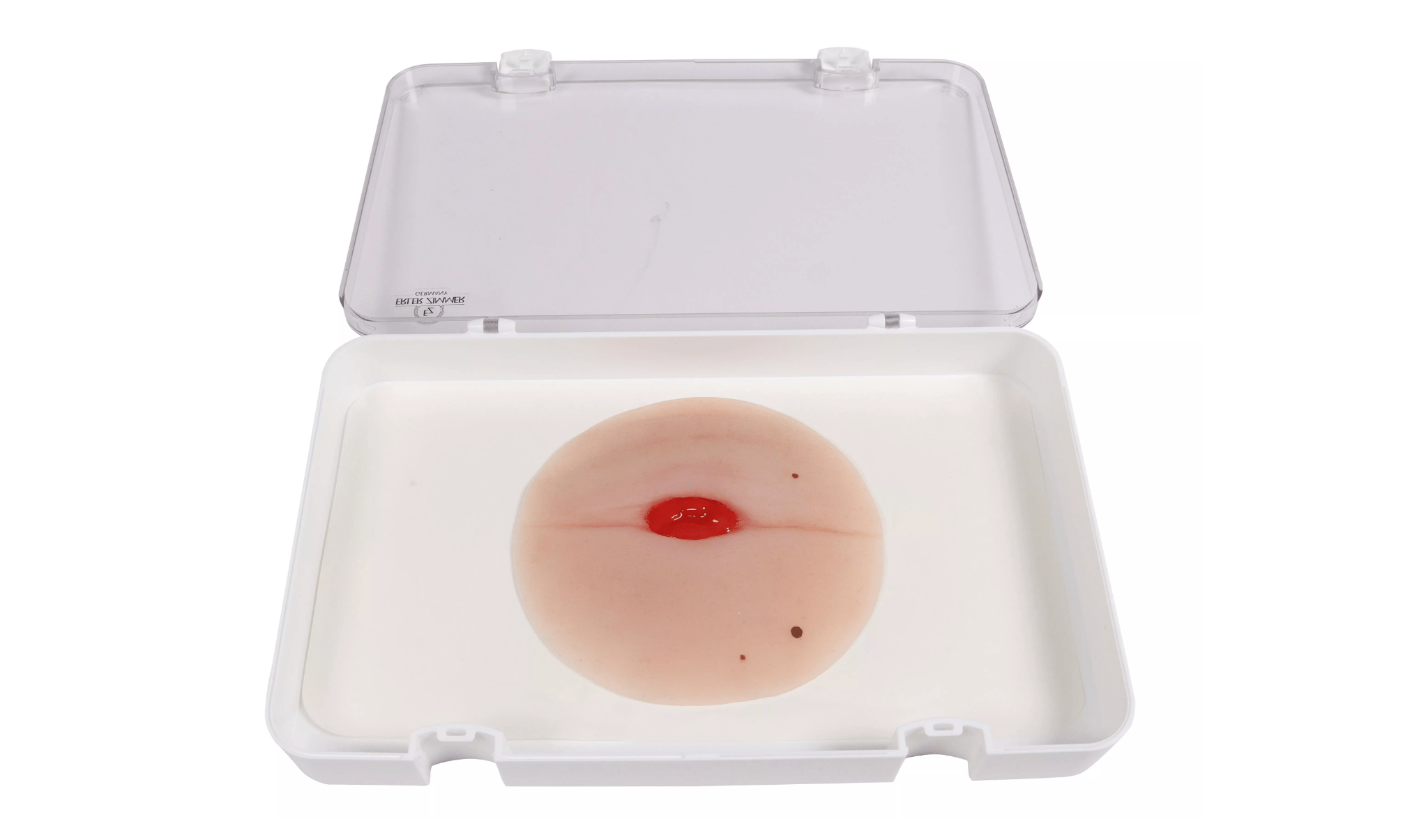 Wundmoulage Kolostoma in Bauchfalte - Erler - Zimmer