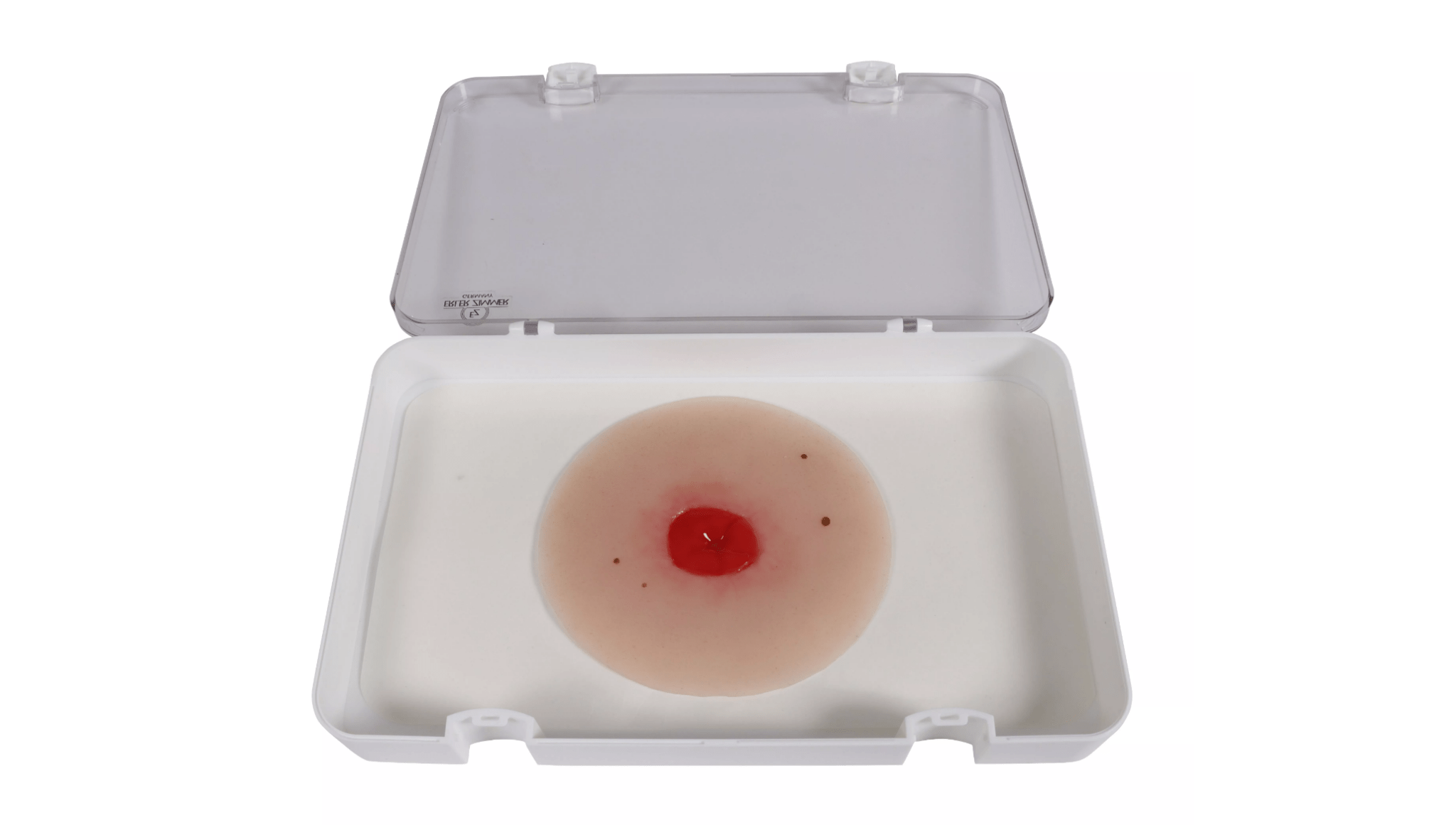 Wundmoulage Kolostoma unter Hautniveau - Erler - Zimmer