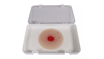 Wundmoulage Kolostoma unter Hautniveau - Erler - Zimmer