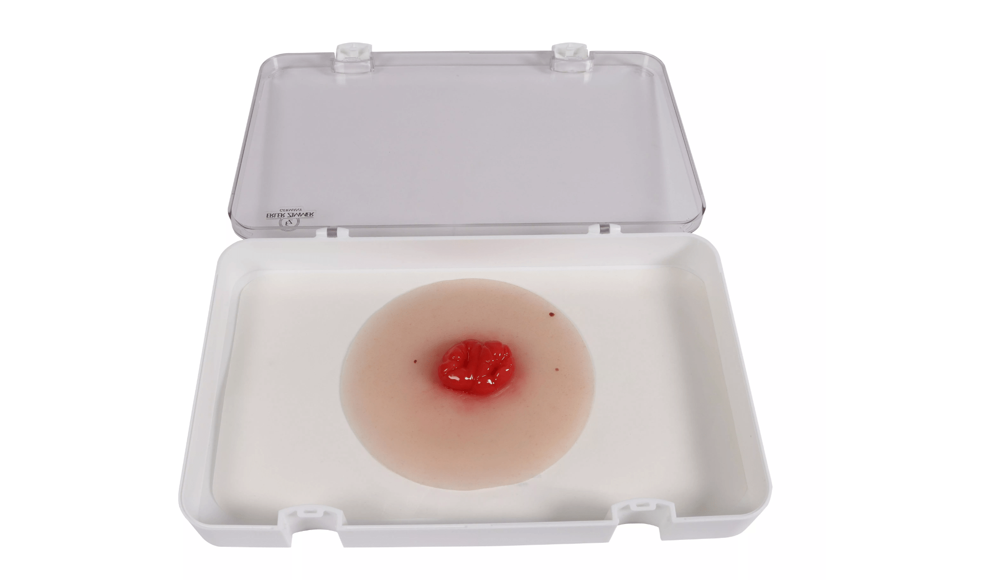 Wundmoulage Kolostoma doppelläufig - Erler - Zimmer