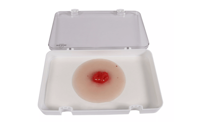 Wundmoulage Kolostoma doppelläufig - Erler - Zimmer