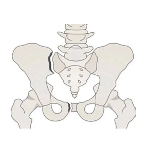 VBM Medizintechnik GmbHBeckenschlingeDocMed GmbH